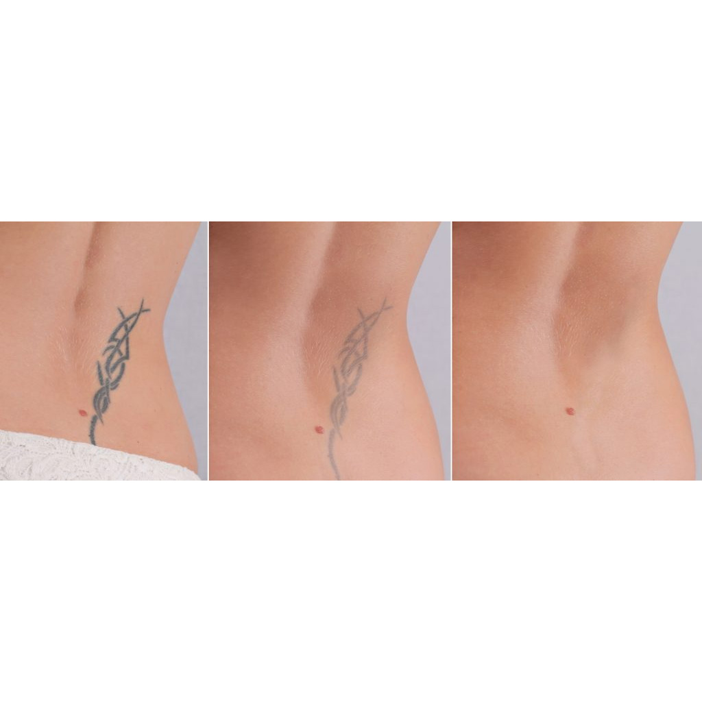 Enzyme Tattoo Removal